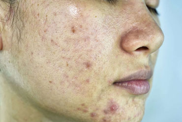 Ayurvedic treatment for skin problems