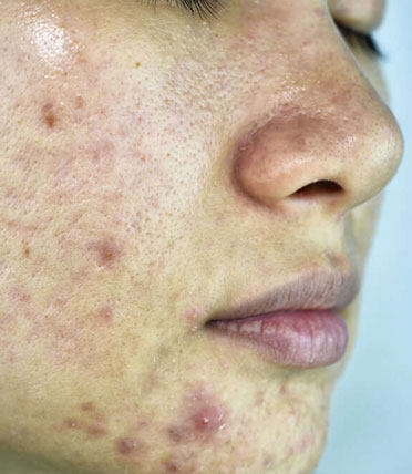 Ayurvedic treatment for Skin Problems
